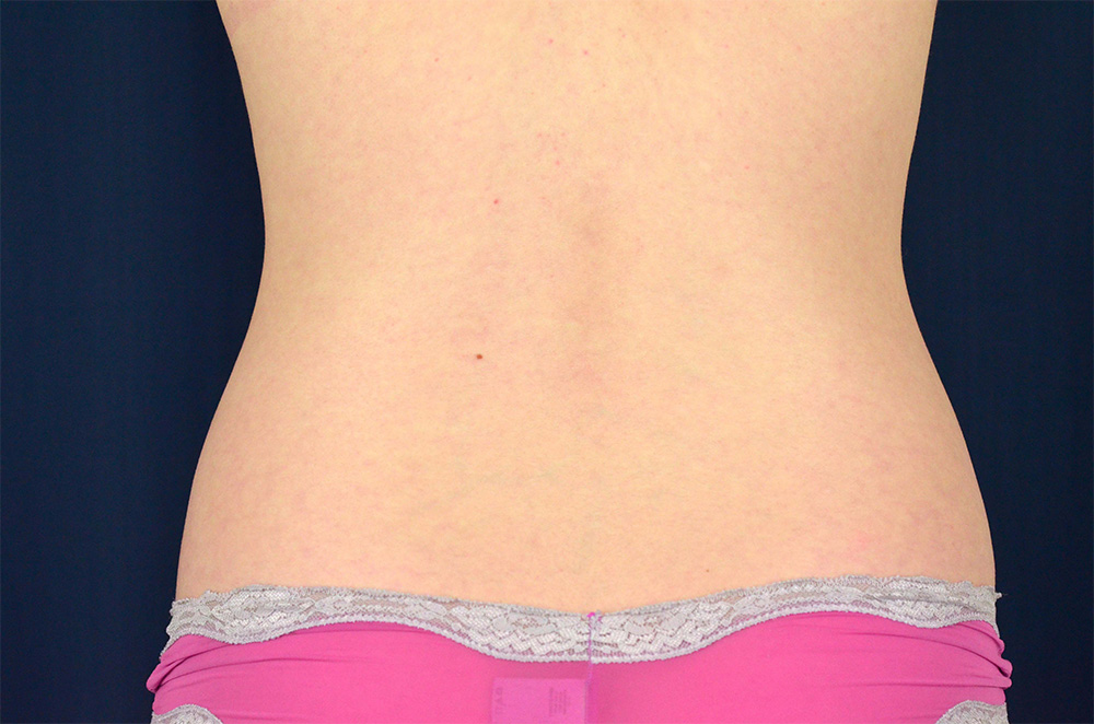 Liposuction