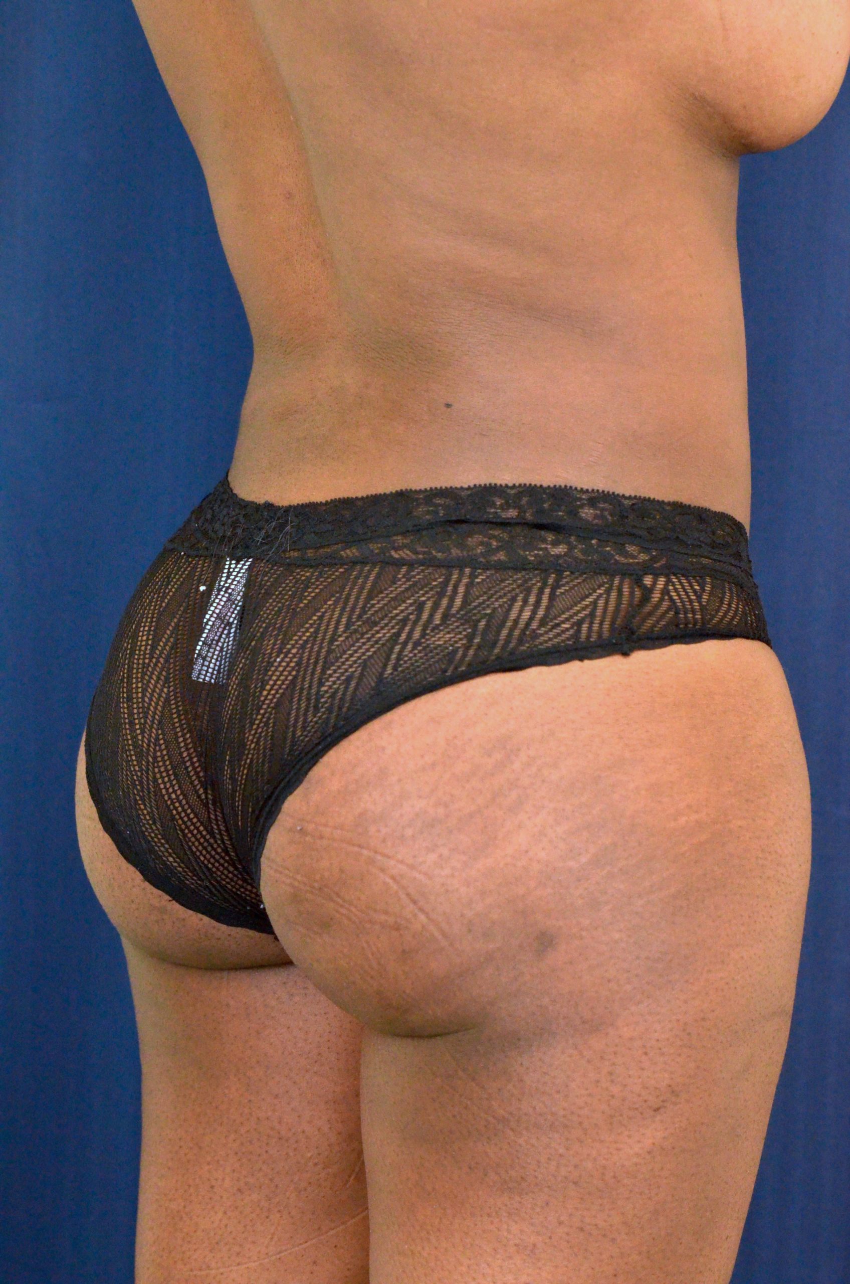 Brazilian Butt Lift Before & After