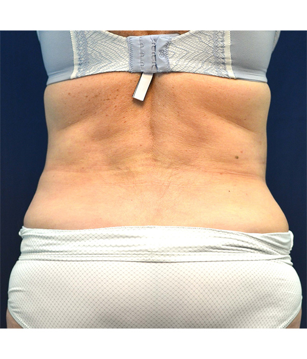 Tummy Tuck