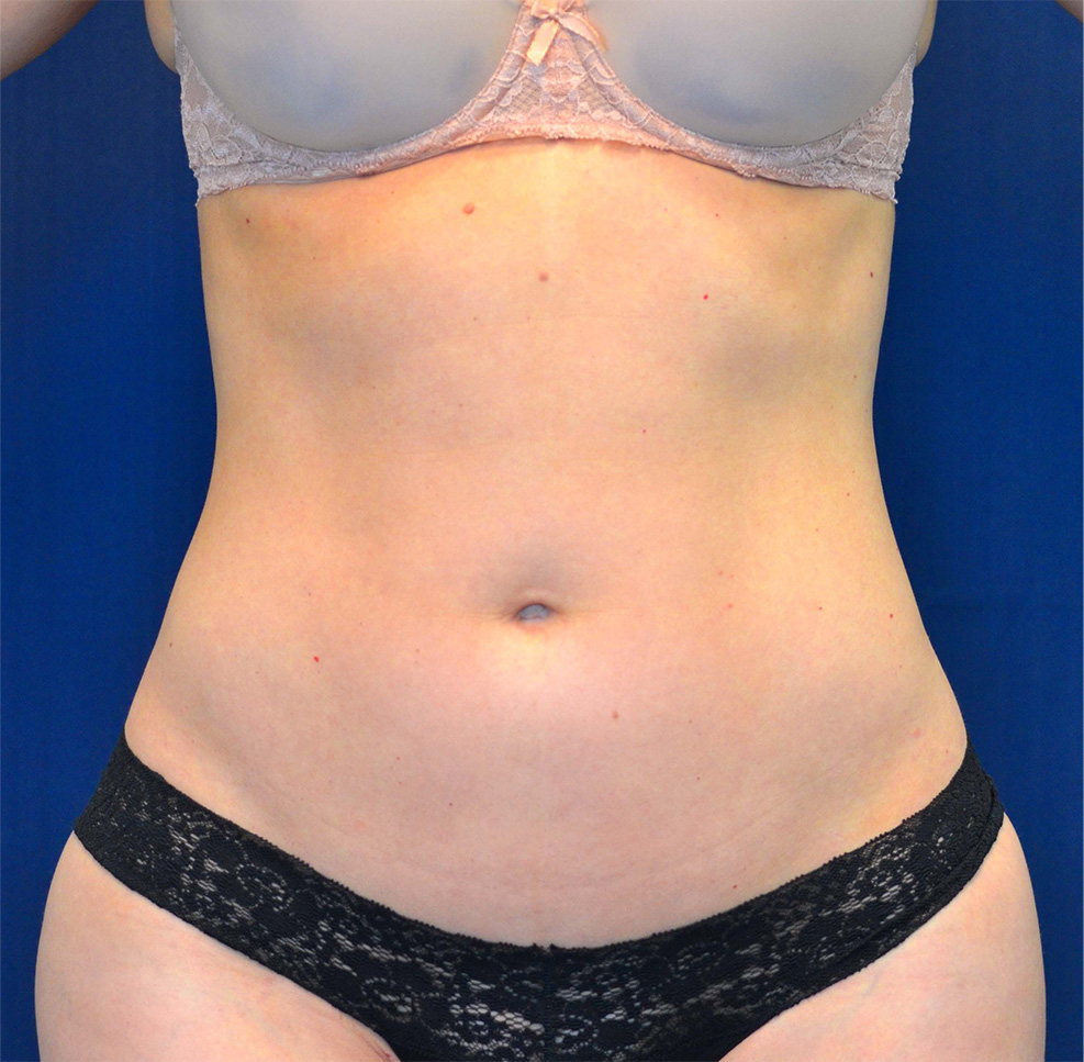 Liposuction