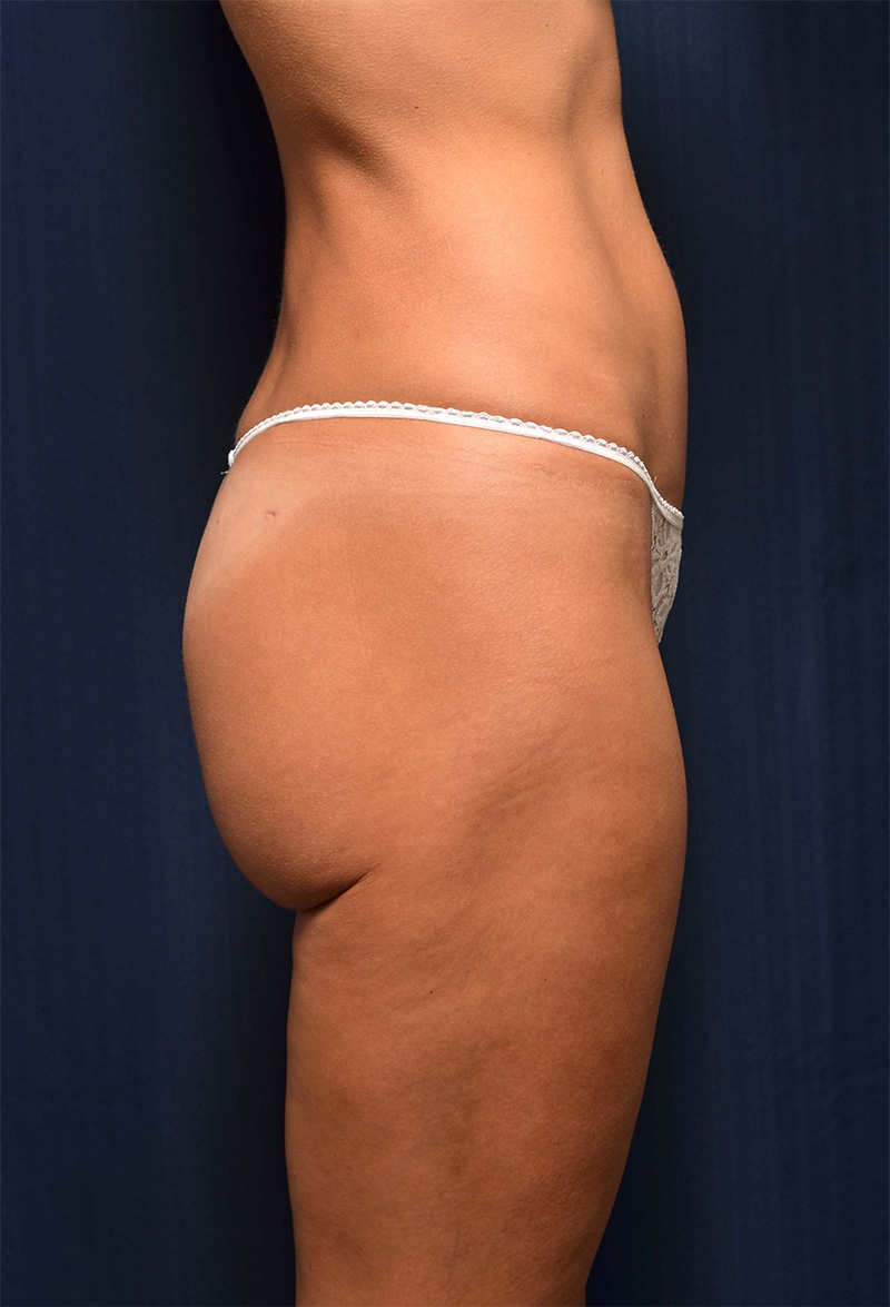 Brazilian Butt Lift Before & After