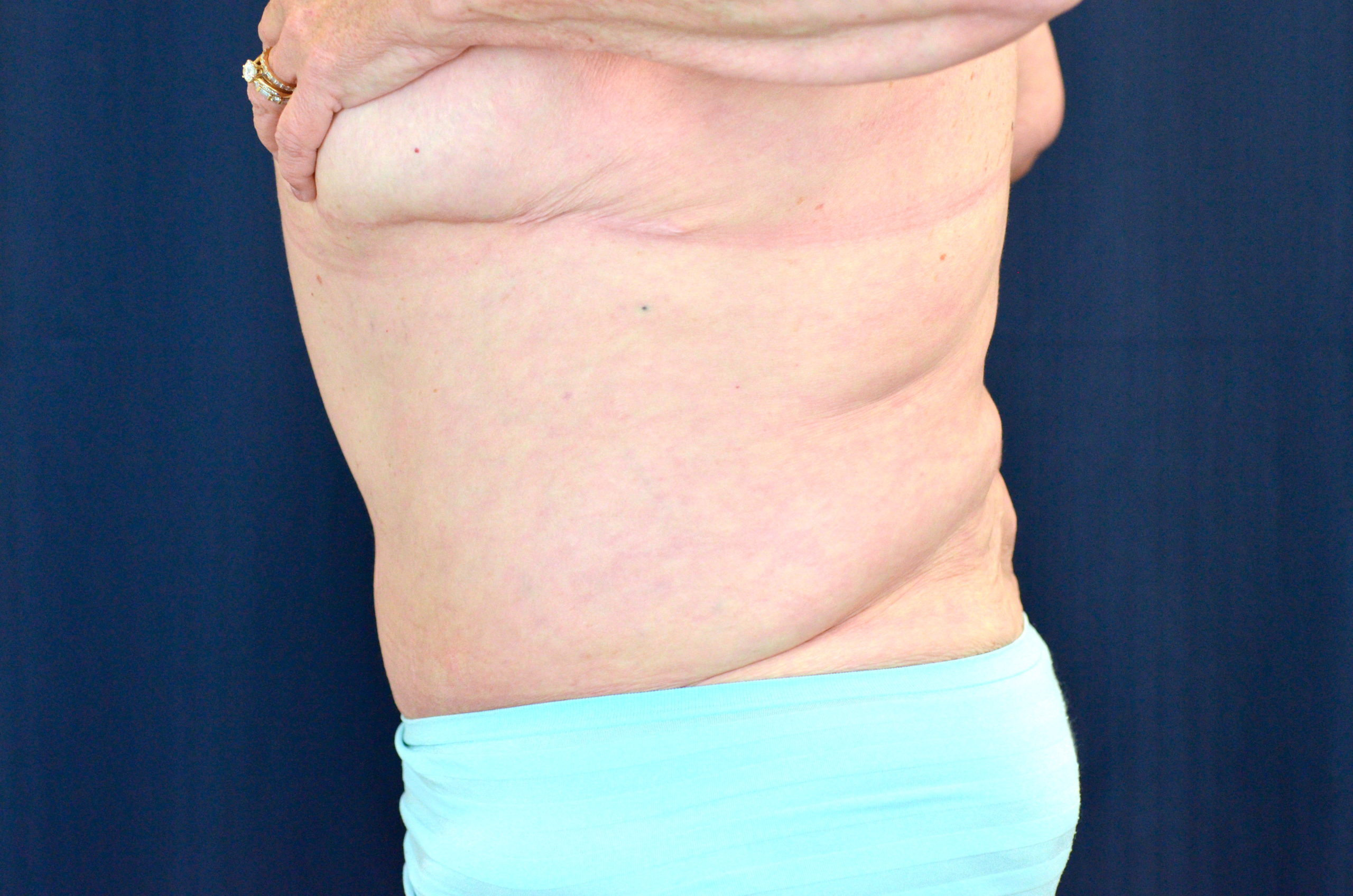 Tummy Tuck