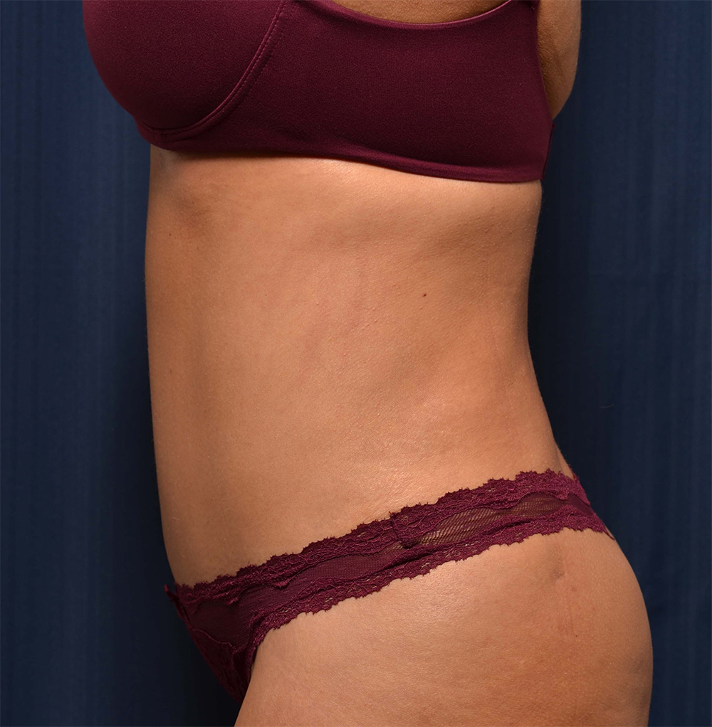 Tummy Tuck