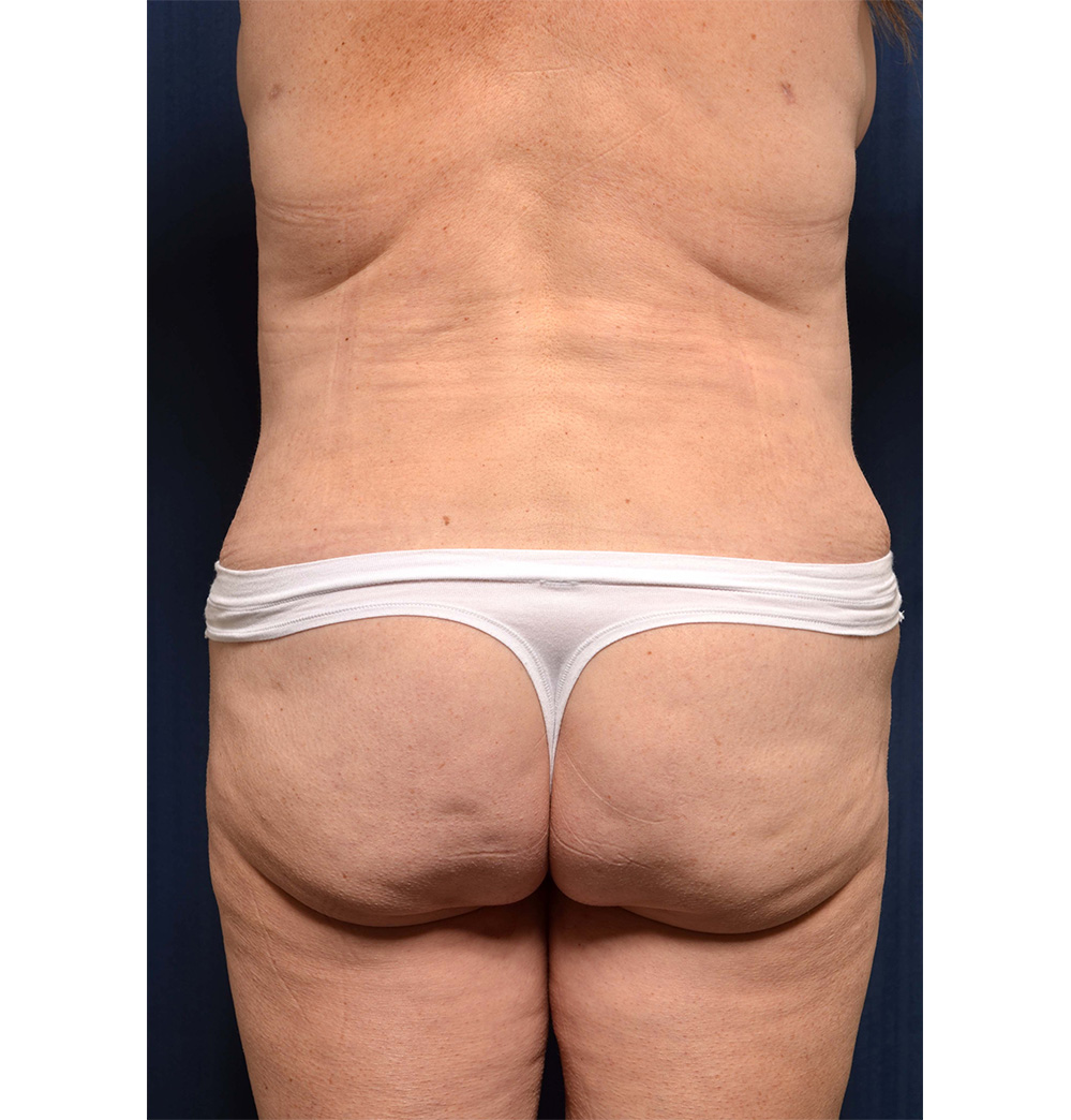 Tummy Tuck