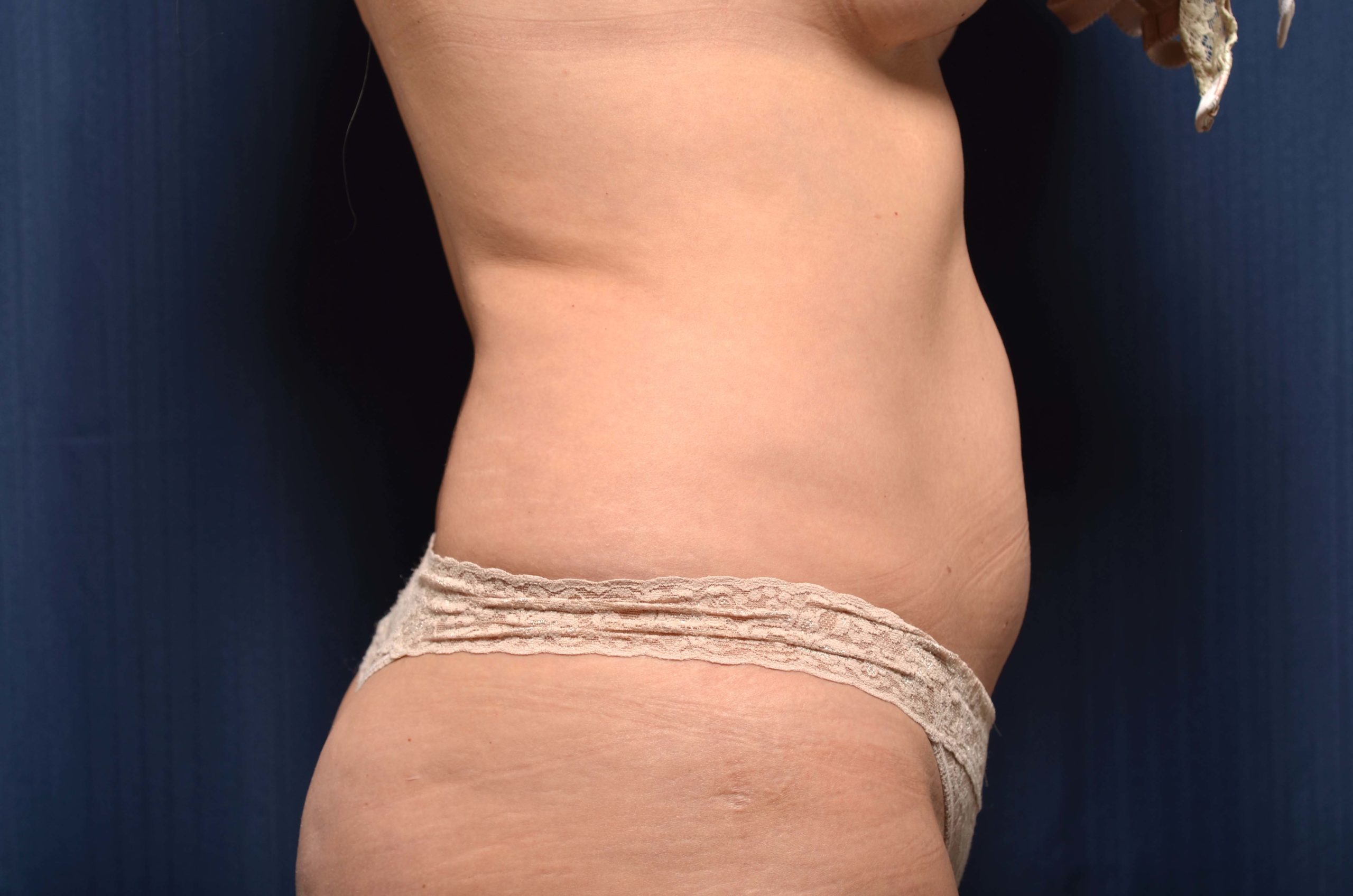 Liposuction