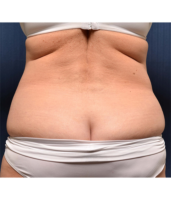 Tummy Tuck