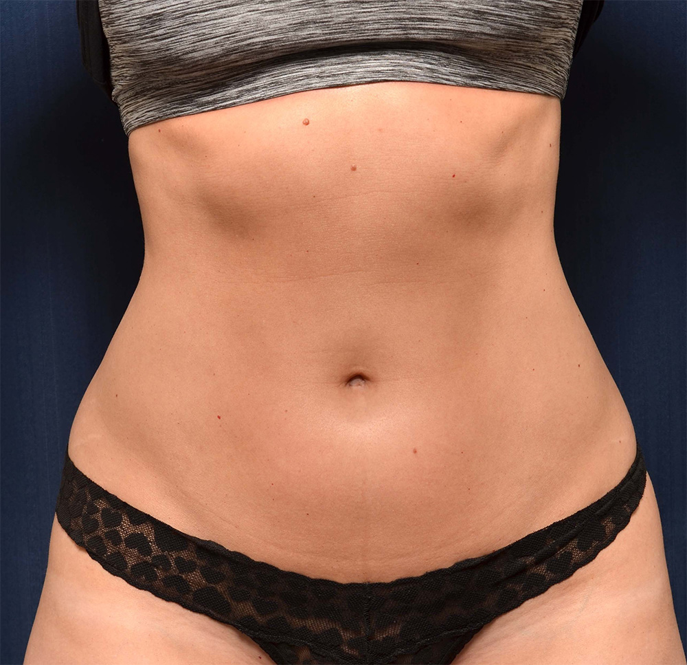 Liposuction