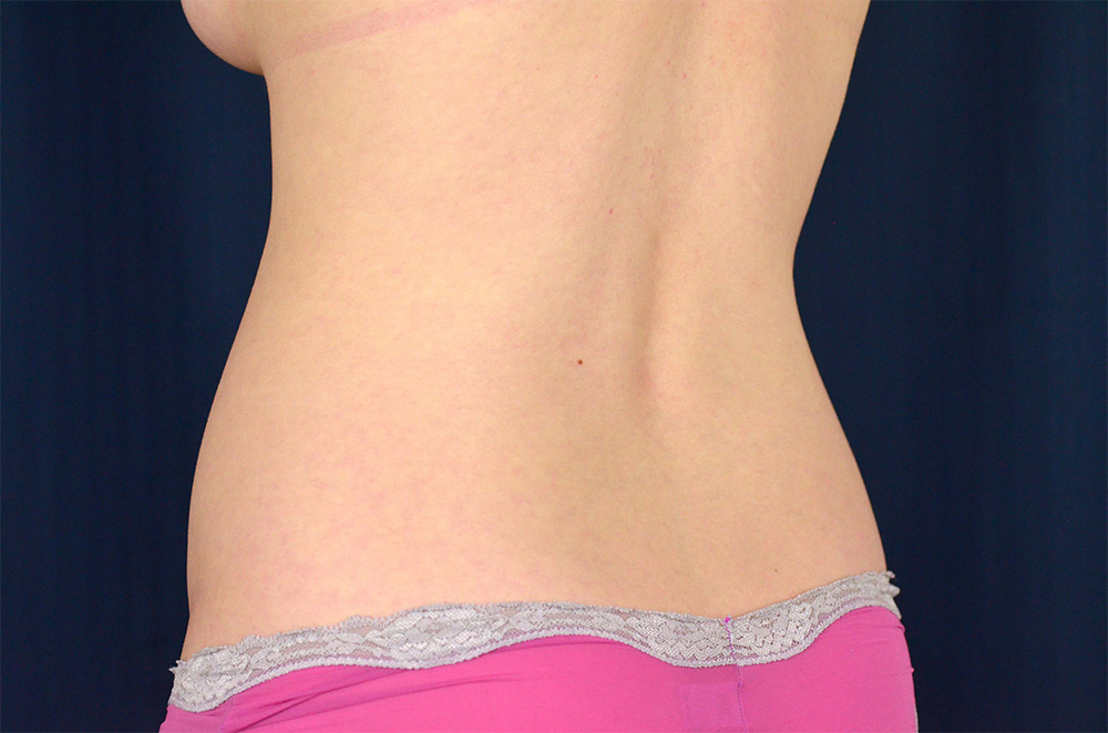 Liposuction