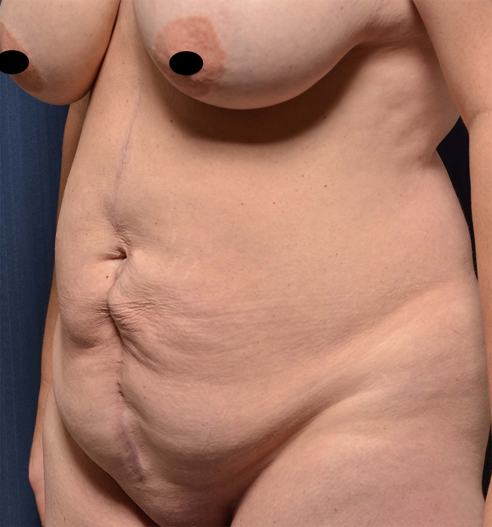 Tummy Tuck