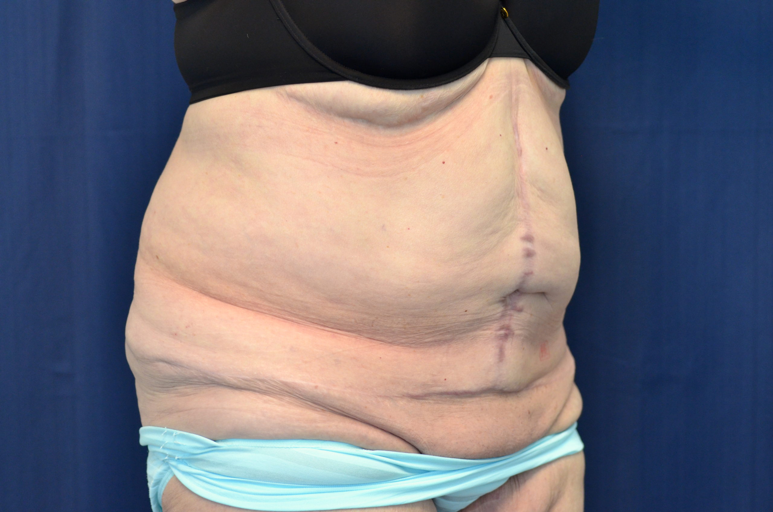 Tummy Tuck