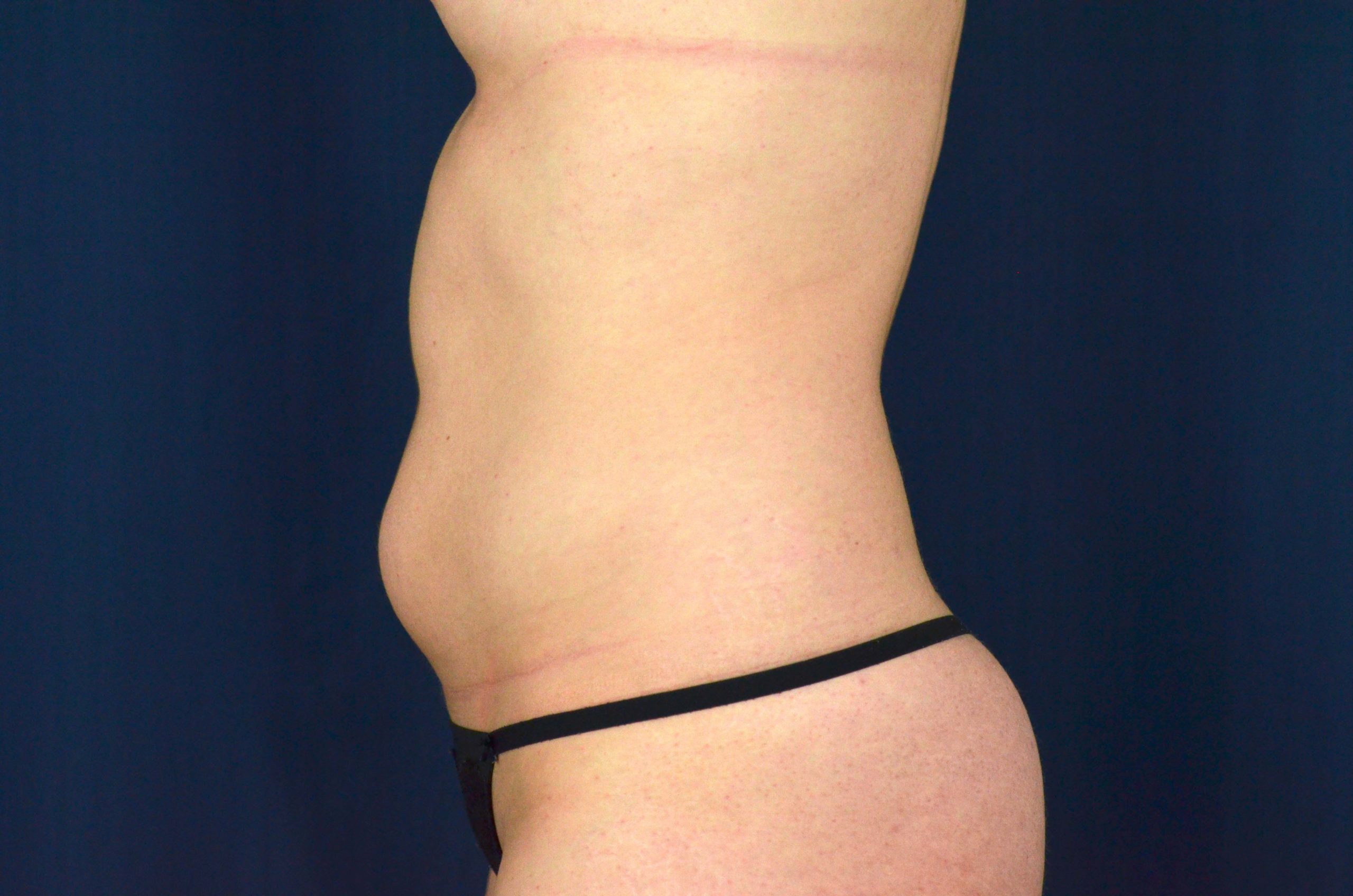 Liposuction