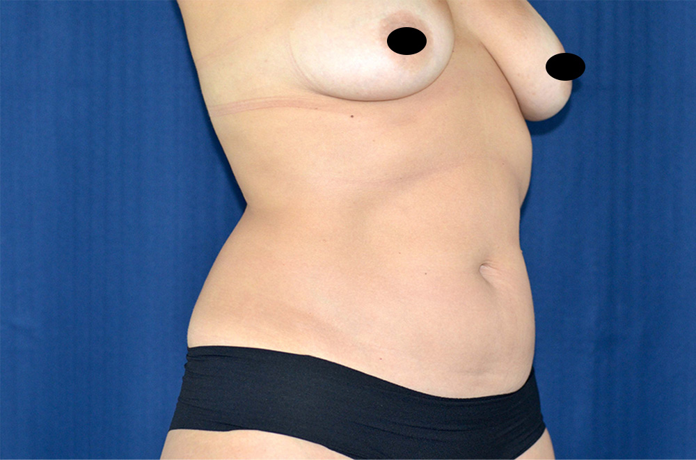 Liposuction