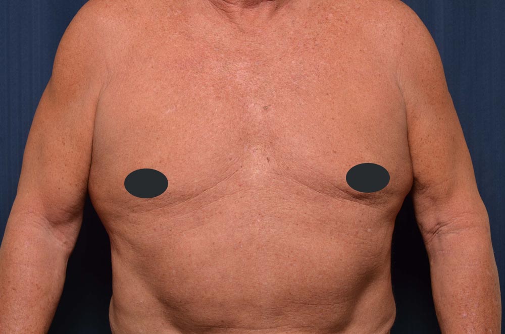 Gynecomastia
