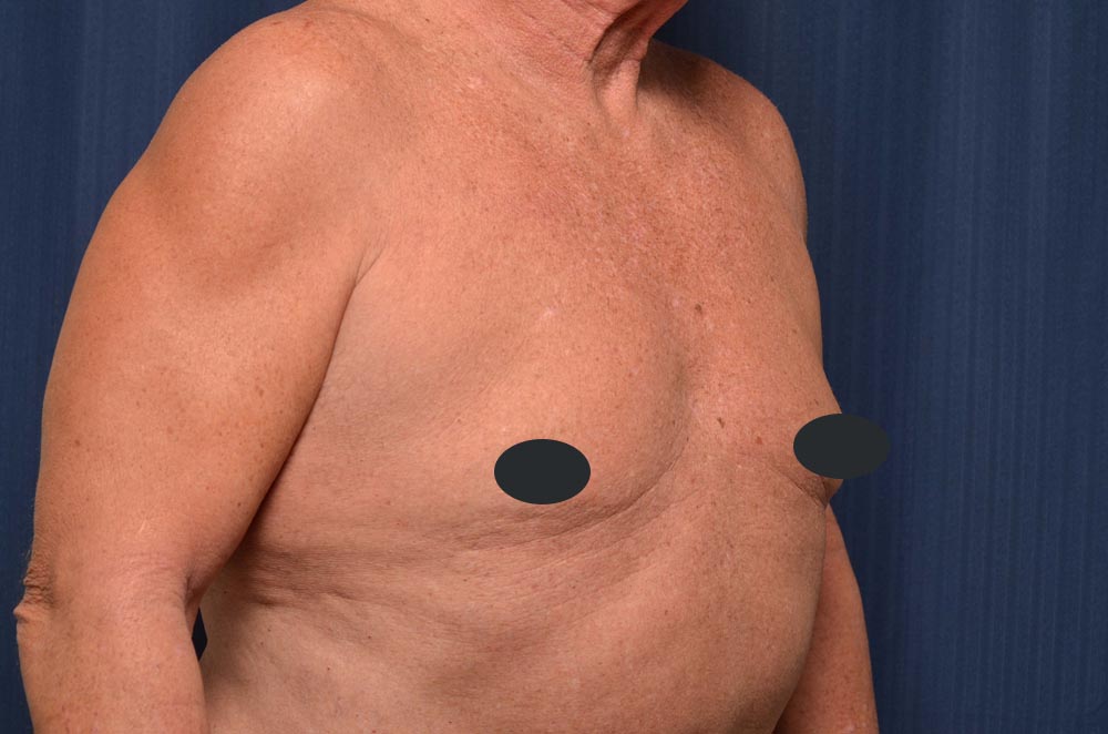 Gynecomastia