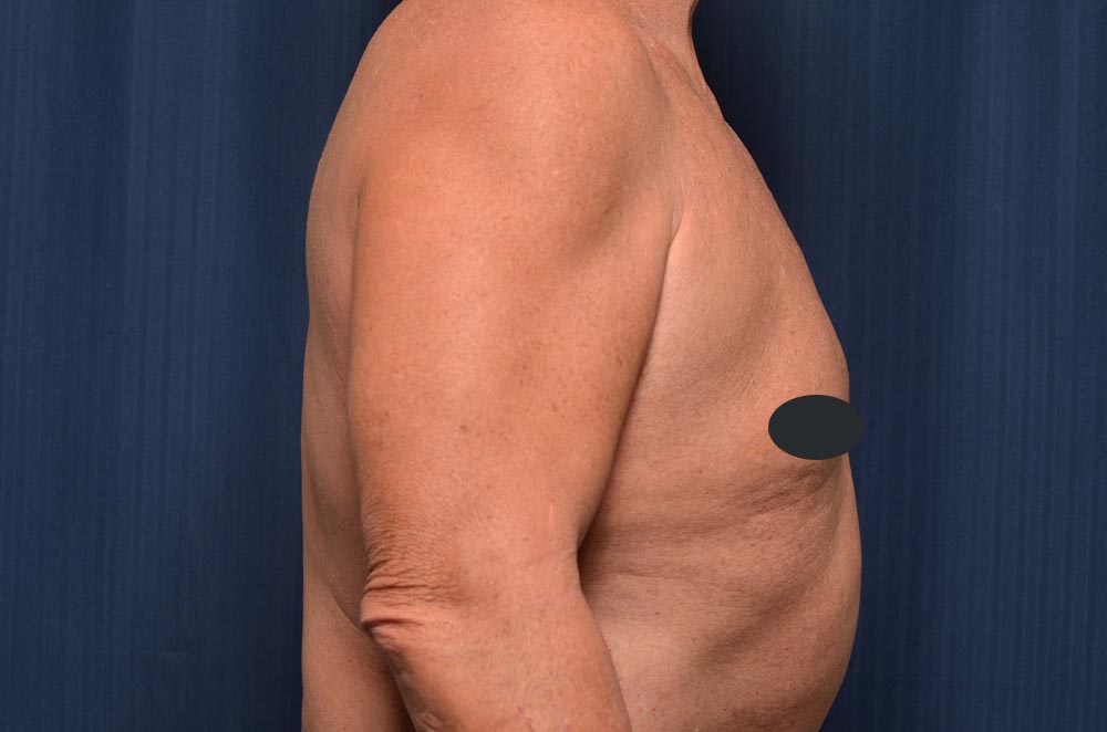 Gynecomastia