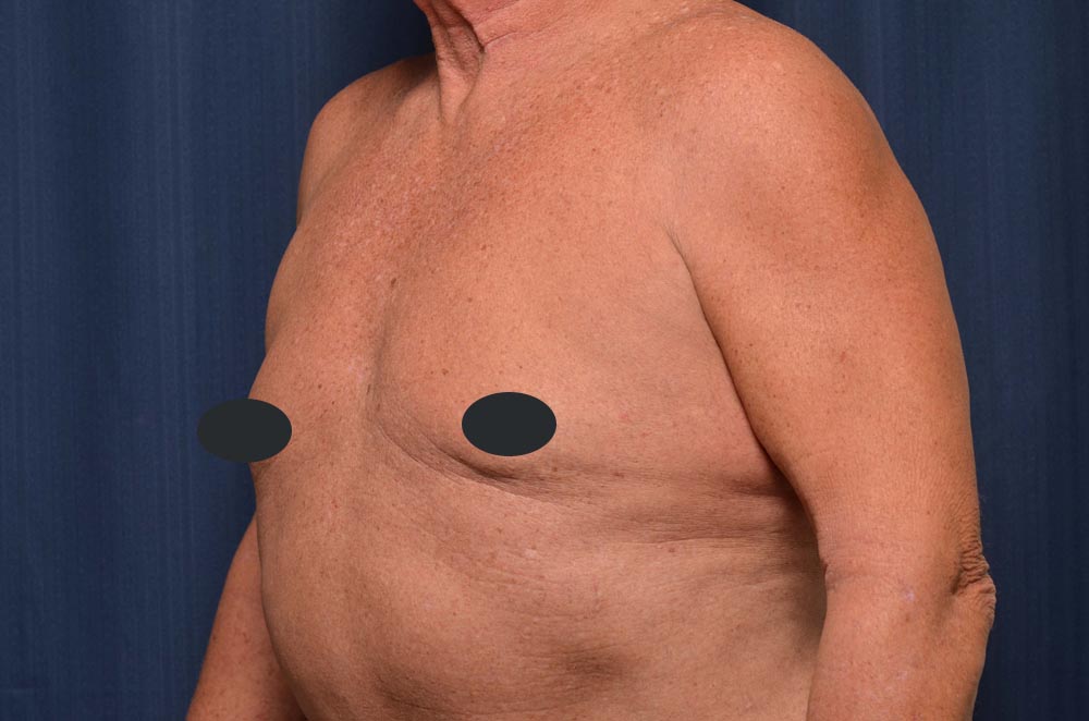 Gynecomastia