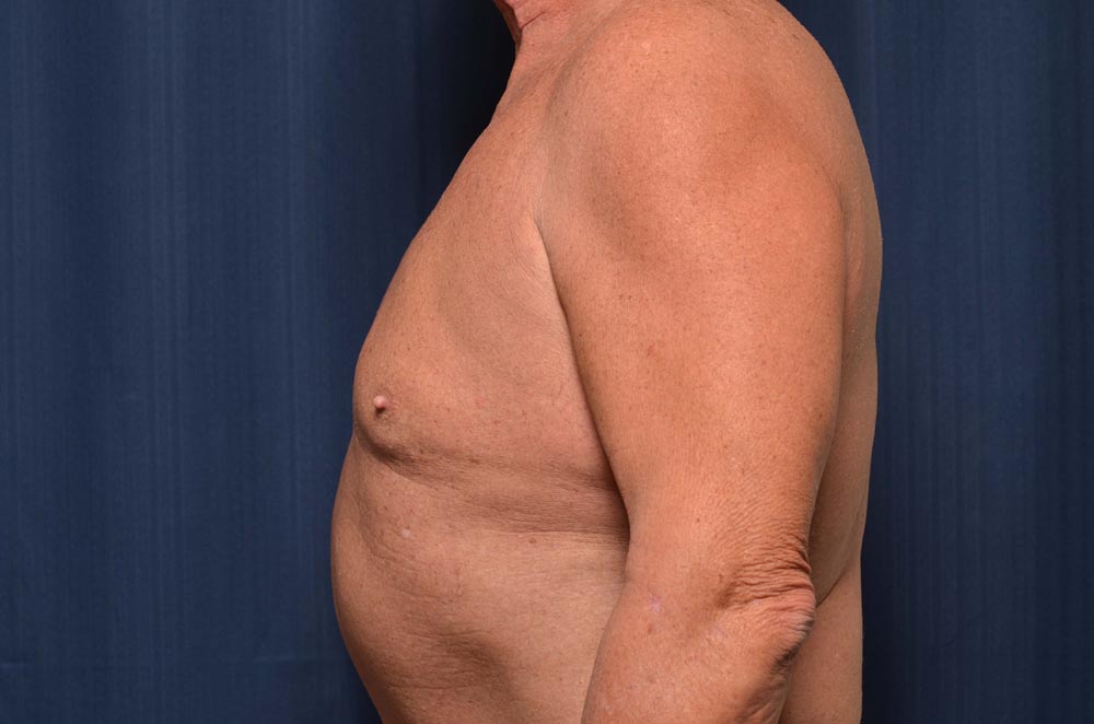 Gynecomastia