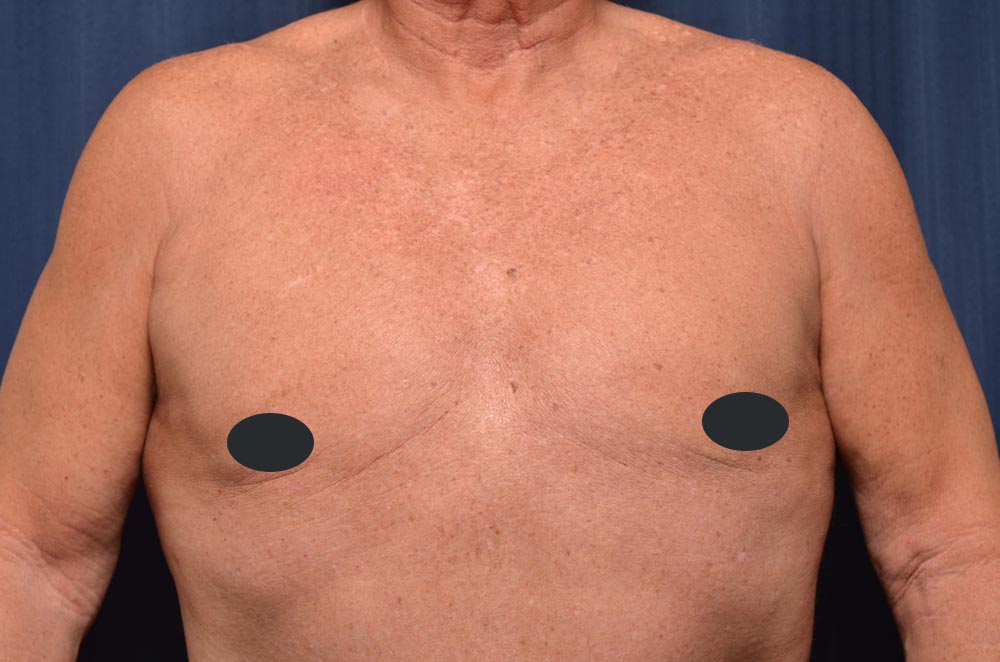 Gynecomastia