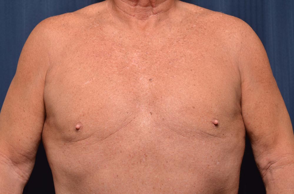 Gynecomastia