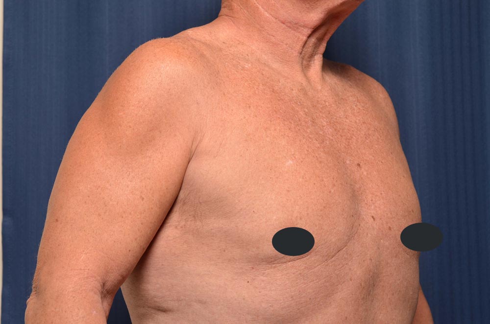 Gynecomastia