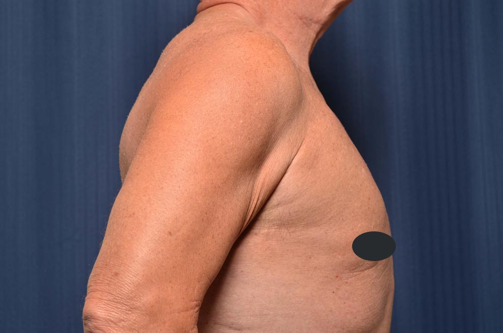 Gynecomastia