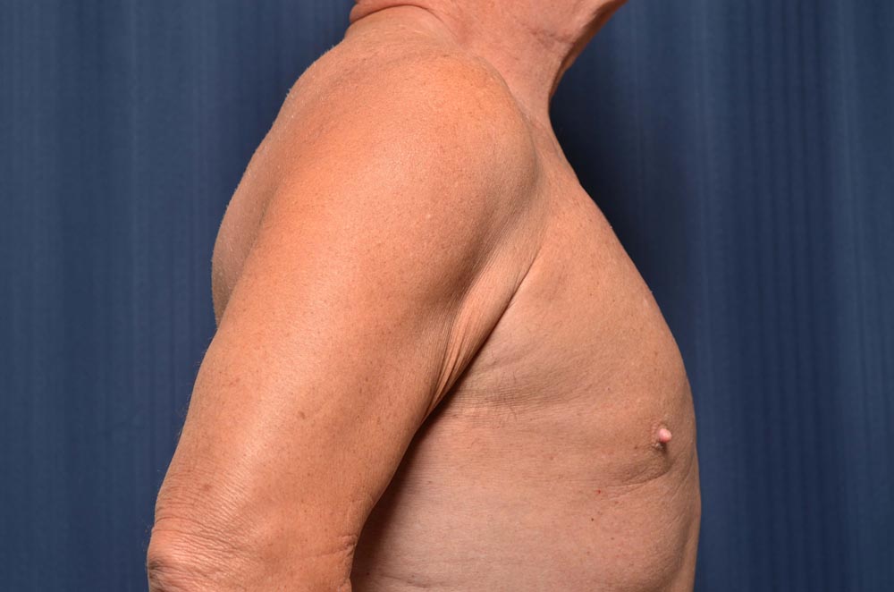 Gynecomastia