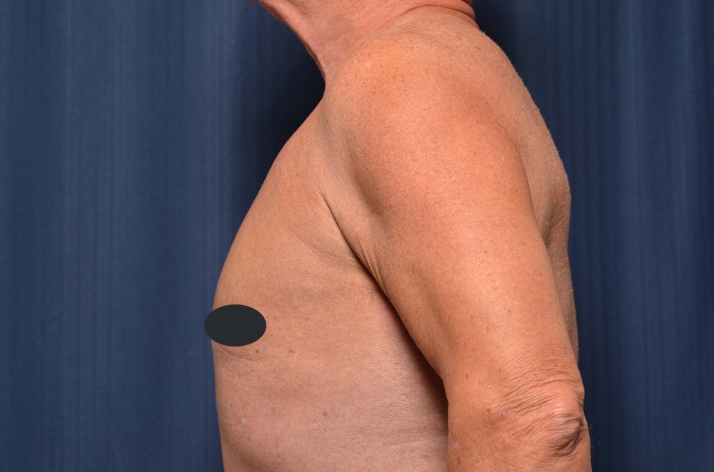 Gynecomastia