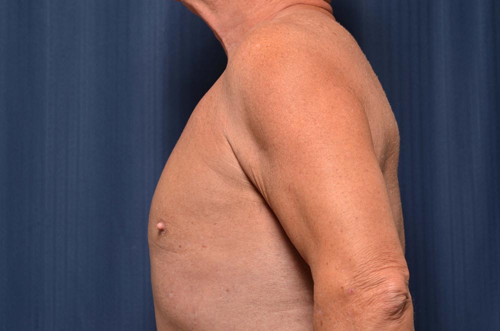 Gynecomastia