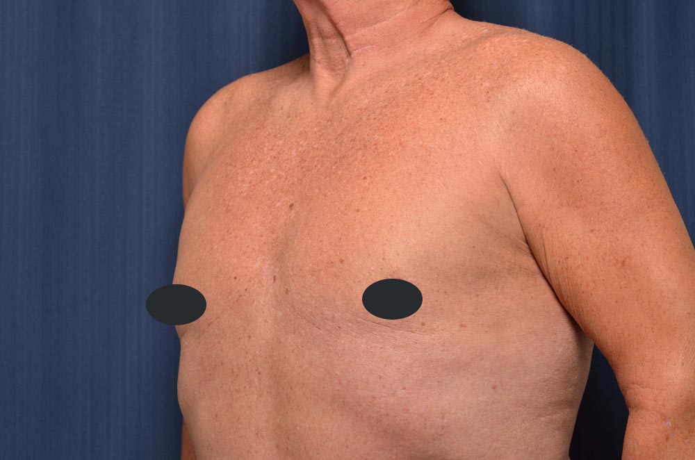 Gynecomastia