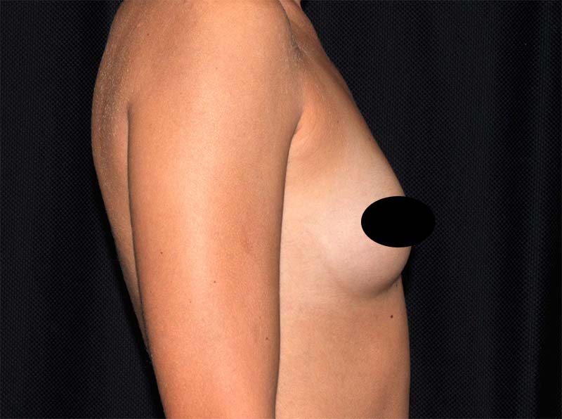 Breast Augmentation Before and After