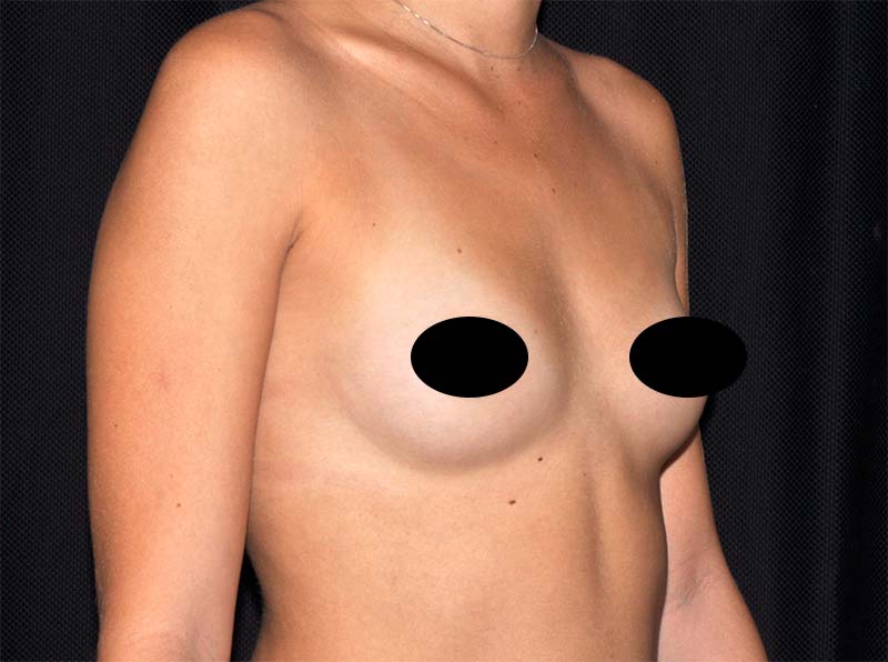 Breast Augmentation Before and After