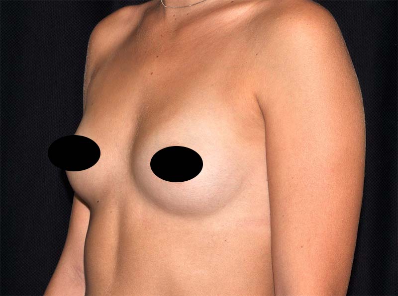 Breast Augmentation Before and After