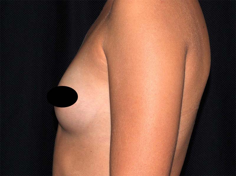 Breast Augmentation Before and After