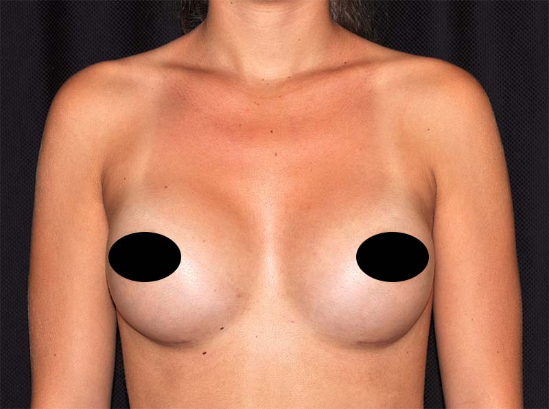 Breast Augmentation Before and After