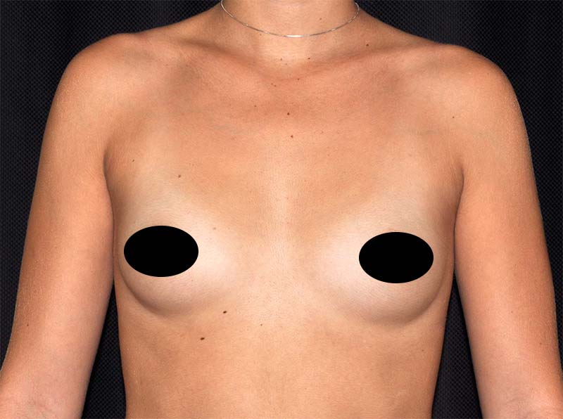 Breast Augmentation Before and After