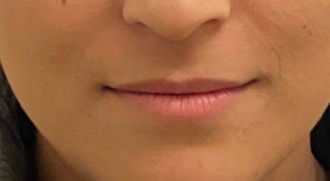 Le Spa Plastic Surgery Before and After Photos