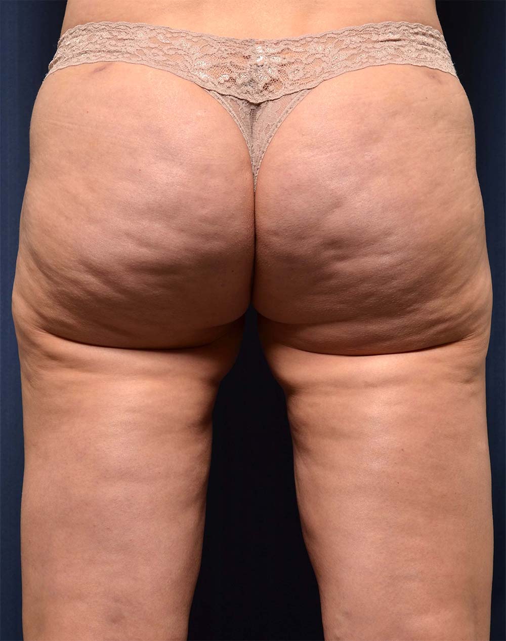 Liposuction