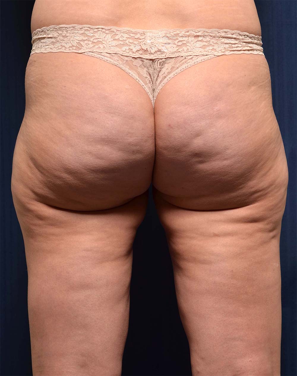 Liposuction