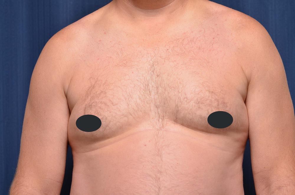 Gynecomastia