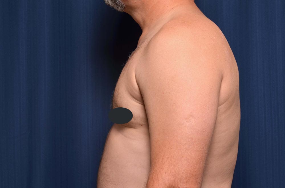Gynecomastia