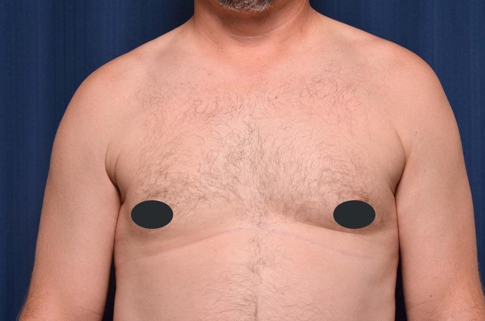 Gynecomastia