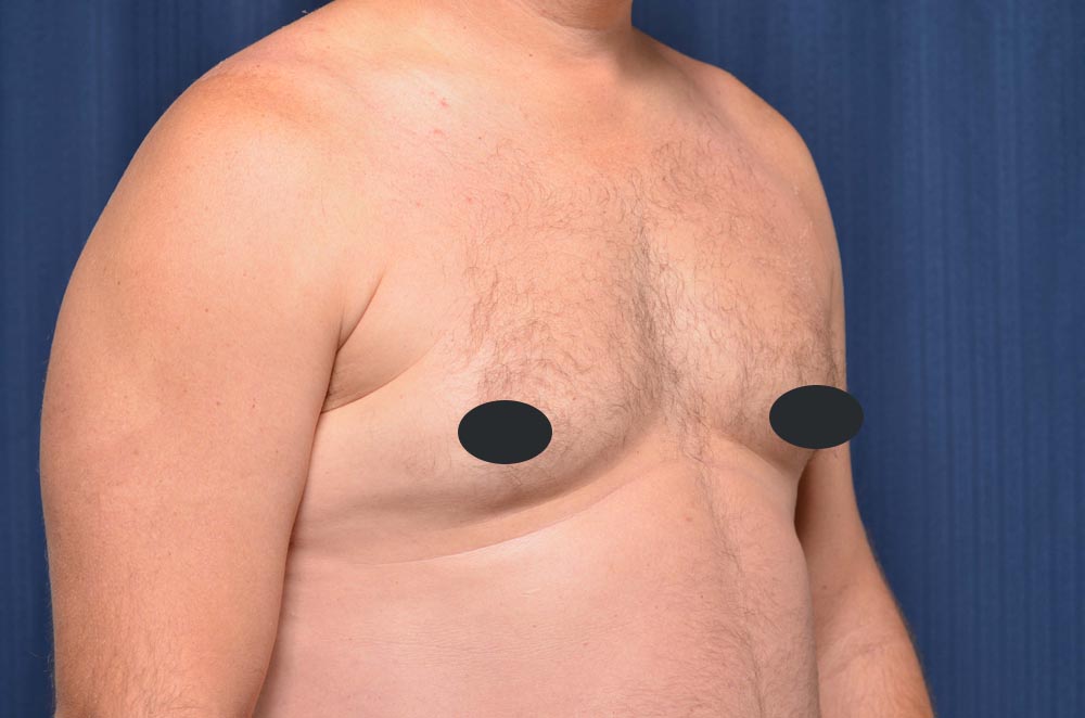 Gynecomastia