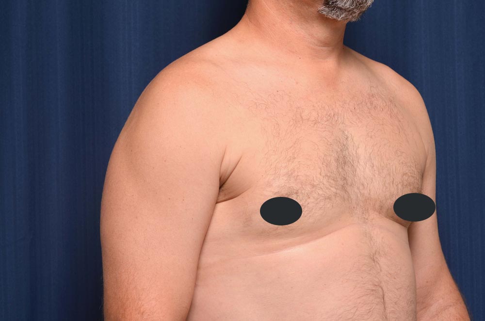 Gynecomastia