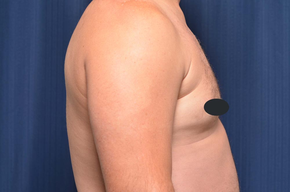 Gynecomastia