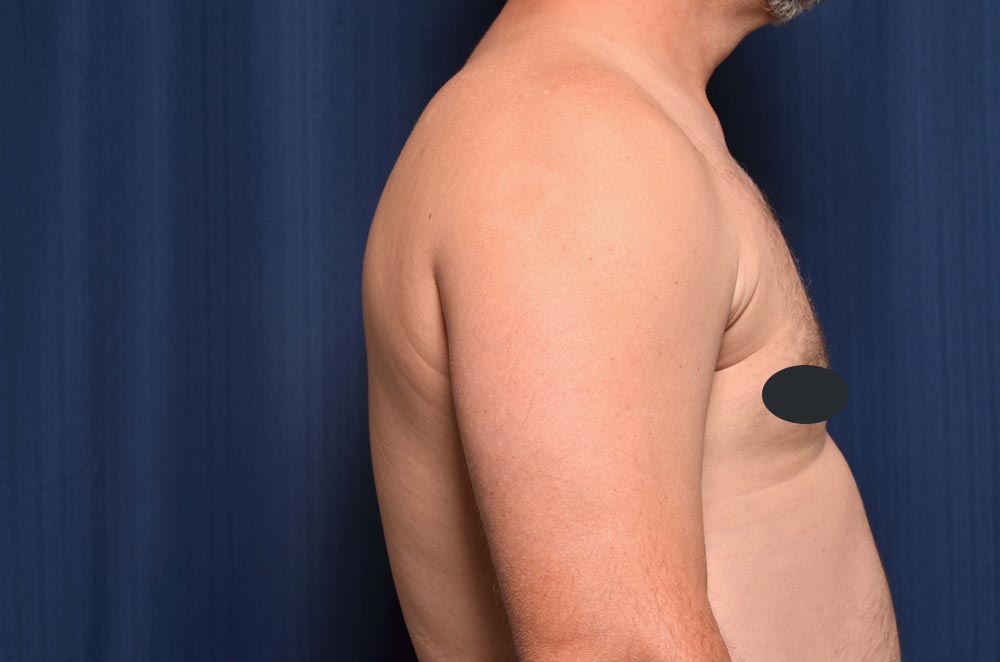 Gynecomastia