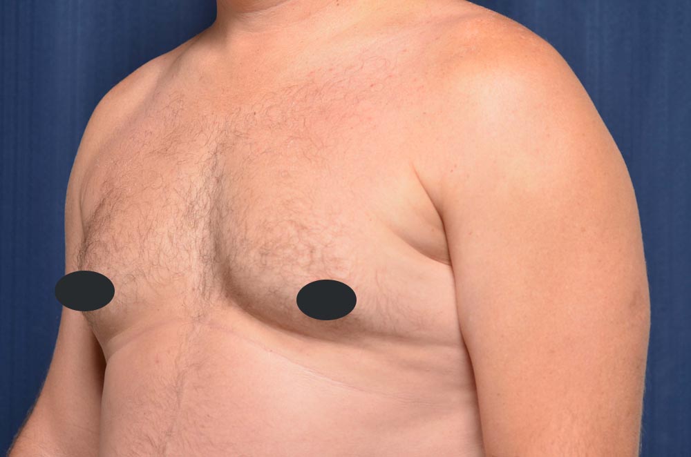 Gynecomastia