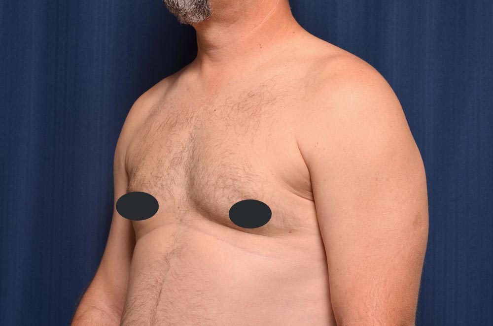 Gynecomastia