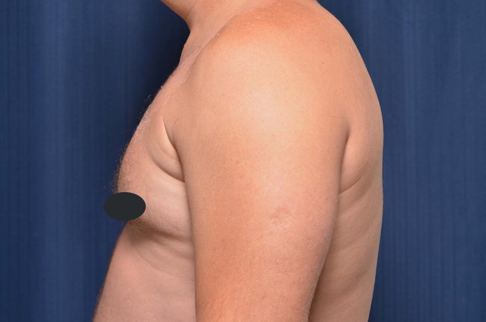 Gynecomastia