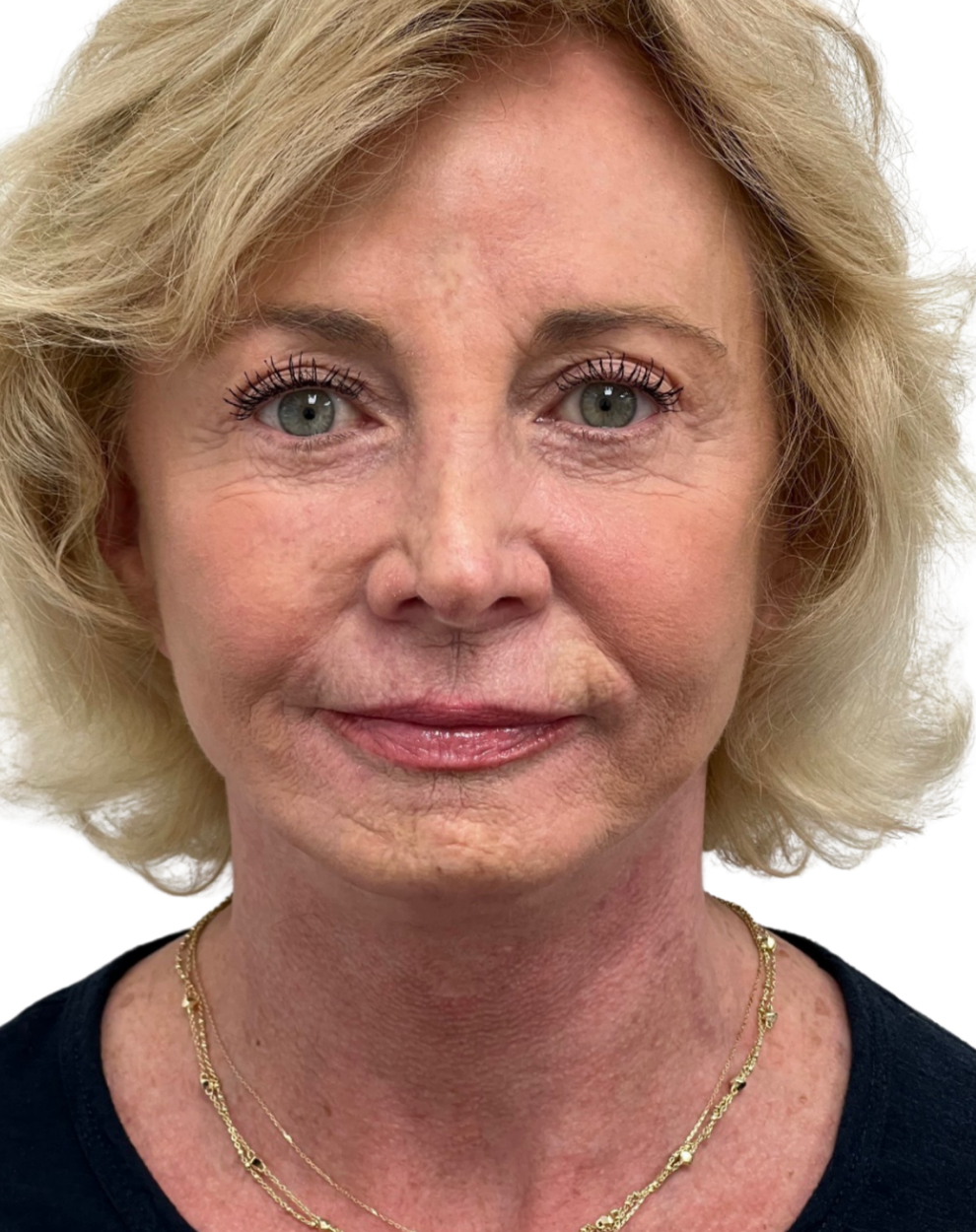 Facelift / Neck Lift
