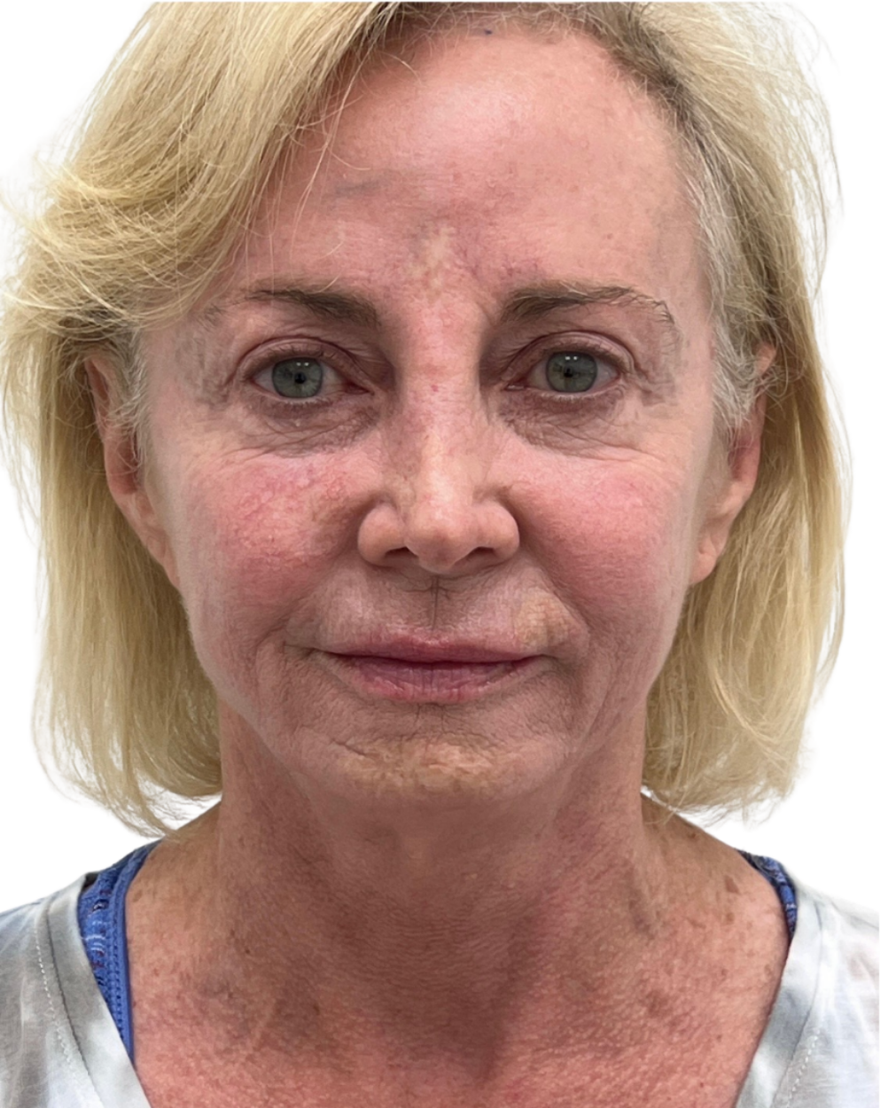Facelift / Neck Lift
